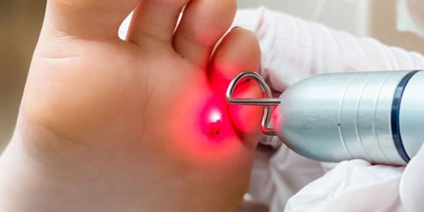 K Laser Verruca Treatment Medway Kent